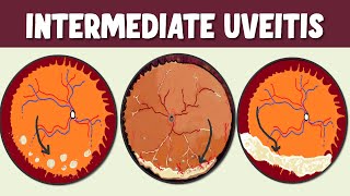 Intermediate Uveitis Spotlight on Symptoms Signs and Potential Complications [upl. by Odlonra]