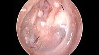 Otoendoscopy  Retracted Ear Drum [upl. by Marashio]