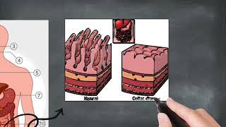 Coeliac Disease PBD [upl. by Reddy184]