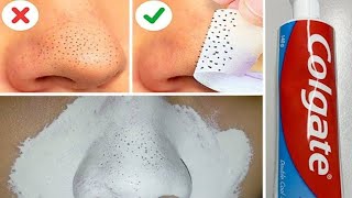 How To Remove BLACKHEADS at Home  In Just 5 Mints Best Way to Remove BLACKHEADS With Toothpaste [upl. by Wassyngton]