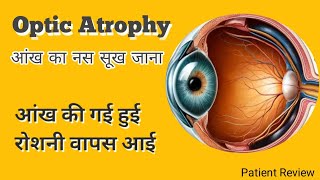 Optic Atrophy आंख का नस सूख जाना   Ayurveda Eye treatments [upl. by Anihsak]