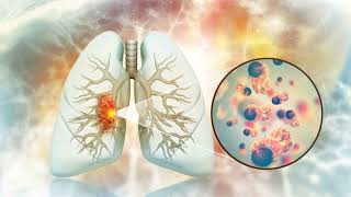 Epidemiology of Lung Cancer Pathophysiology mortality survival rate [upl. by Lili443]