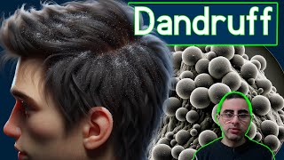 Top 5 Causes of Dandruff and How to Fight Them [upl. by Ema]