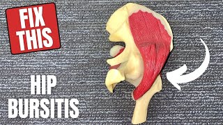 Hip Trochanteric Bursitis  What It Is Causes and Treatment [upl. by Letsirc995]