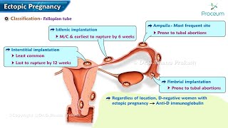 Ectopic Pregnancy Classification Pathogenesis Clinical features Diagnosis amp Treatment [upl. by Ahtekal417]