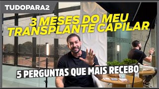 tudopara2  3 meses após transplante capilar com Dr Anderson Lima  5 perguntas que mais recebo [upl. by Osrit671]