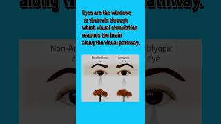 Amblyopia youtubeshorts vision video viralshorts [upl. by Yenatirb895]