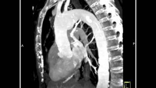 4D Imaging of the Aortic Valve Arch Pseudoaneurysm 3 of 8 [upl. by Na654]