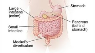 Mcqs on Meckel’s diverticulum surgerysurgeryeducationneetpg [upl. by Main]