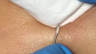 Ingrown Hairs Extraction  16 minutes [upl. by Ramirol]