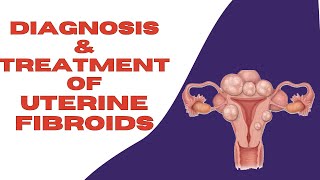 What Are The Treatments For Uterine Fibroids  How To Get Rid of Fibroids [upl. by Enegue]