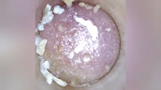 Most Satisfying Blackhead Removal Pore Vacuum w Classical Music ASMR  brpvph compilation [upl. by Ainesell892]