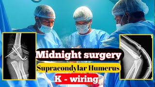 Vlog 5  We Performed Surgery On A Broken Elbow At Midnight doctor hospital vlogs [upl. by Alyakem]