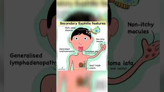 SECONDARY SYPHILIS FEATURES RRBDSSSBMSNSYPHILISNURSINGUPCHOBIHARCHO [upl. by Epul591]