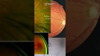 White Dot Syndromes ophthalmology optometry uveitis eyedisease choroidopathy [upl. by Drud]