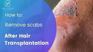 How to Get Rid of Scabs After Hair Transplant  Heva Clinic [upl. by Susanna]