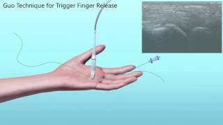 Trigger Finger Release [upl. by Dennis]