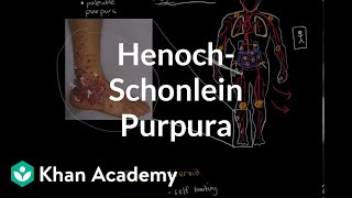 HenochSchonlein purpura  Circulatory System and Disease  NCLEXRN  Khan Academy [upl. by Grissel]