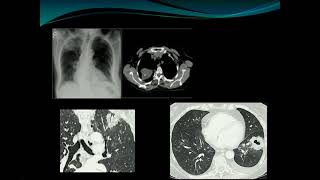 Stratification of lung nodules and the new Fleischner guidelines  Theresa McLoud [upl. by Kerk]