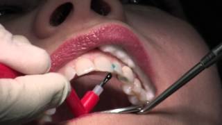 Composite Fillings [upl. by Glen197]