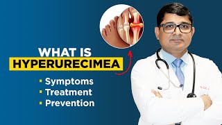 What is Hyperuricemia   Causes  Signs  Diagnosis by Dr DK Gupta [upl. by Aridatha]