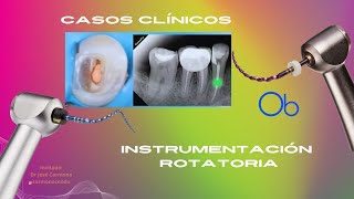 CASOS CLÍNICOS con Instrumentación Rotatoria en Endodoncia [upl. by Katti]