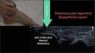 Deltoid Ligament Ultrasound 2023 [upl. by Leiuqeze460]