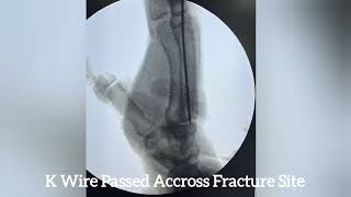 CRIF WITH ANTE GRADE CRIF K WIRE FIXATION FOR 3RD METACARPAL SHAFT FRACTURE IN A YOUNG MALE [upl. by Fornof]