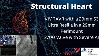 VIV TAVR with a 29mm S3 Ultra Resilia in a 29mm Perimount2700 Valve with Severe AI [upl. by Batista]