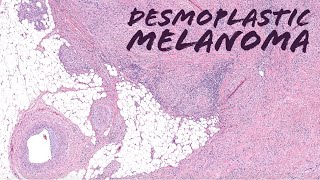 Desmoplastic Melanoma with Immunohistochemistry UNC Case 1 dermpath dermatology pathology [upl. by Minny265]