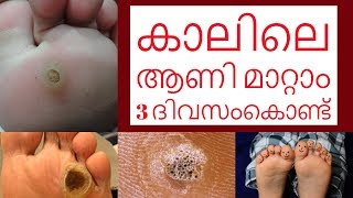 Corn disease a solution  Mohanan Vaidyar  Malayalam [upl. by Arissa]