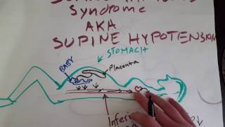 EMT Supine Hypotension  EMT MADE EASY [upl. by Alliscirp684]