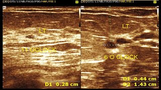 Ultrasound cases 167 of 2000  Fibrocystic Disease Both Breast [upl. by Elyag]