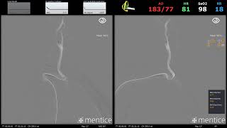 NV Connect  Acute Ischemic Stroke [upl. by Attenauq692]