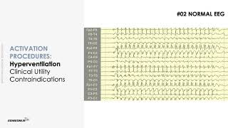 ACTIVATION PROCEDURES ON EEG  LEARN ADULT EEG [upl. by Herc842]