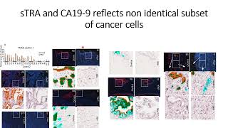 sTRA amp CA199 glycans express nonidentical subset of pancreatic cancer cell populations Code 695 [upl. by Ahsenre]