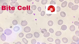 Heinz Bodies And Bite Cells In Periphral Blood Smear [upl. by Hcardahs]