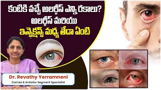 Conjunctivitis Causes Symptoms and Treatment  Types of Eye Infections  Smart Vision Eye Hospital [upl. by Ybor]