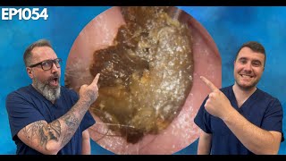 Removing Massive Ear Wax Blockages  EP1054 [upl. by Erapsag]