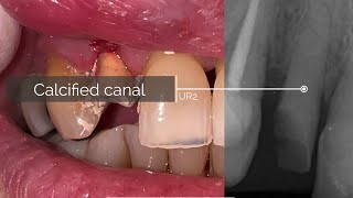 UR2 Calcified RCT Quick clinical case [upl. by Drofyar343]