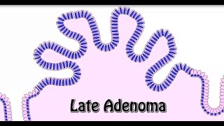 Animated Histology Colon Cancer Progression [upl. by Sale]