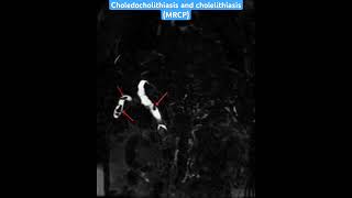 MRI case 65 Choledocholithiasis and cholelithiasis MRCPradiology mri radiologist mrcp [upl. by Adim]