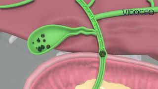 Spanish ERCP Description for Choledocholithiasis [upl. by Voltmer348]