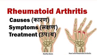 Rheumatoid Arthritis  Symptoms Causes Dignosis Treatment  Science Explored  Arthritis [upl. by Adonis]