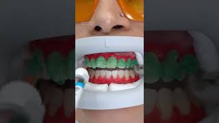 Laser teeth whitening before and after shorts teethwhitening dentist beforeafter [upl. by Drusi]