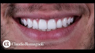 Casos Clínicos Design de Sorriso Para Dentes Conóides  Dr Claudio Romagnoli [upl. by Yerac]