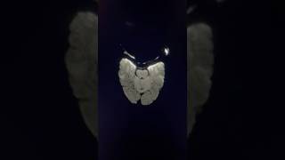 😱Teeth Braces Artifact in mrianatomy radiology shortsvideo radiological shortsviral trending [upl. by Danzig]