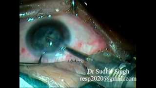 Phaco Surgery With Hydrophoic Aspheric Foldable IOL By Dr Sudhir Singh 55 [upl. by Arzed174]