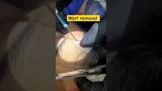 Wart removal on face [upl. by Marv]