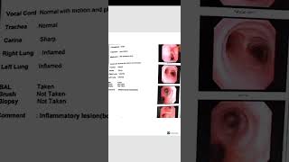 Bronchoscopy  inflammatory lesion [upl. by Ihana]